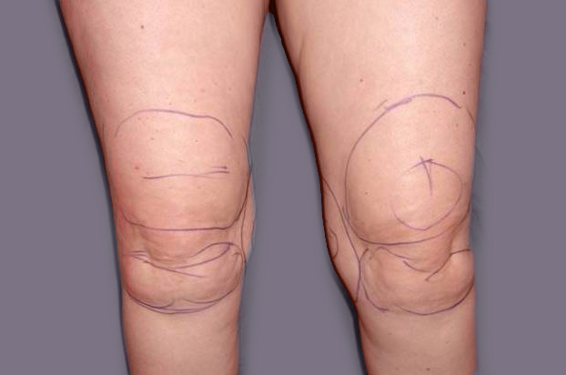 Liposuction - after 6 months